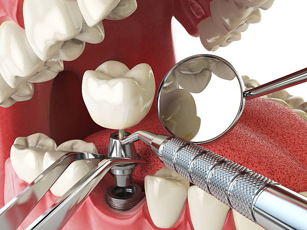 Best Lost Filling or Crown Replacement in La Cienega, NM